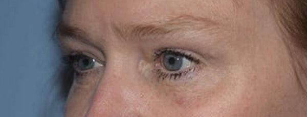 Eyelid Lift Before & After Gallery - Patient 173623664 - Image 4