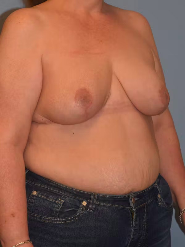 Breast Reduction Before & After Gallery - Patient 173623668 - Image 4