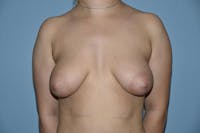Breast Augmentation Lift Before & After Gallery - Patient 173623667 - Image 1