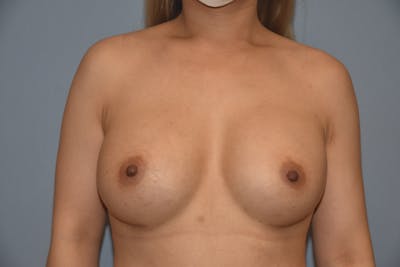 Breast Augmentation Before & After Gallery - Patient 173624149 - Image 2
