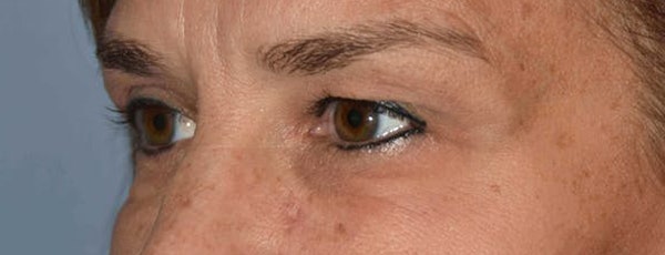 Eyelid Lift Before & After Gallery - Patient 173623704 - Image 3