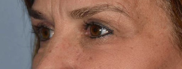 Eyelid Lift Before & After Gallery - Patient 173623704 - Image 4