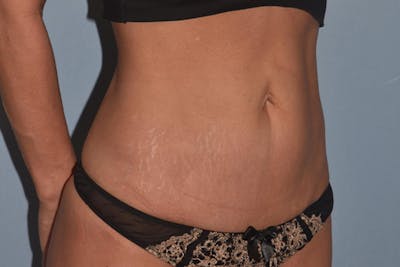 Tummy Tuck Before & After Gallery - Patient 173623802 - Image 4