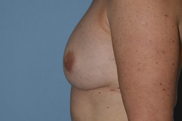 Breast Reconstruction Before & After Gallery - Patient 173623771 - Image 6