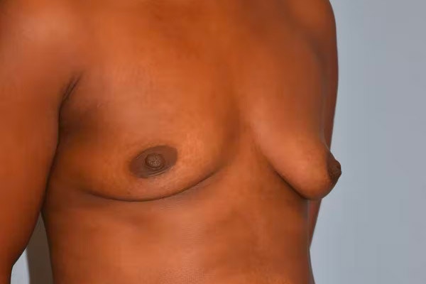 Breast Augmentation Before & After Gallery - Patient 173623886 - Image 3