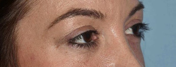 Eyelid Lift Before & After Gallery - Patient 173623880 - Image 3