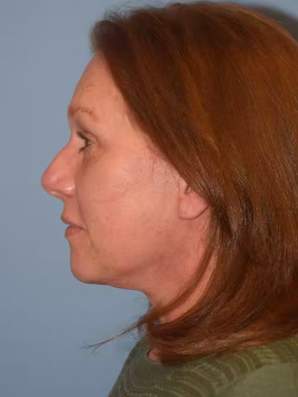 Facelift Before & After Gallery - Patient 173623851 - Image 6