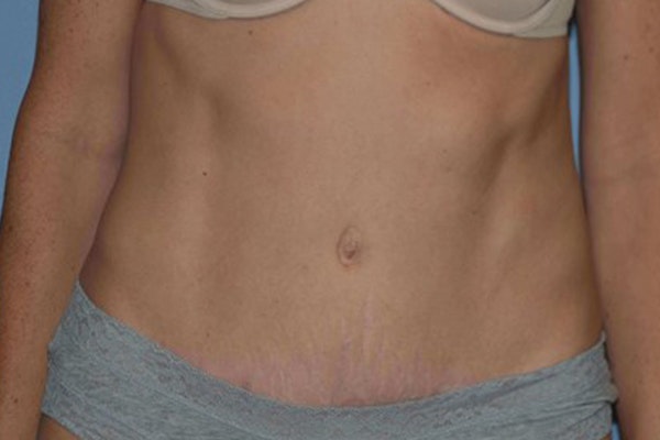 Tummy Tuck Before & After Gallery - Patient 173623994 - Image 2