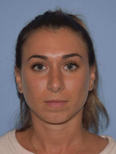 Rhinoplasty Before & After Gallery - Patient 173623879 - Image 6
