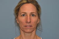 Facelift Before & After Gallery - Patient 173624270 - Image 1