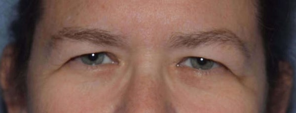 Eyelid Lift Before & After Gallery - Patient 173624004 - Image 1