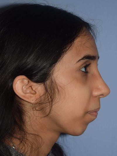 Rhinoplasty Before & After Gallery - Patient 173624007 - Image 2