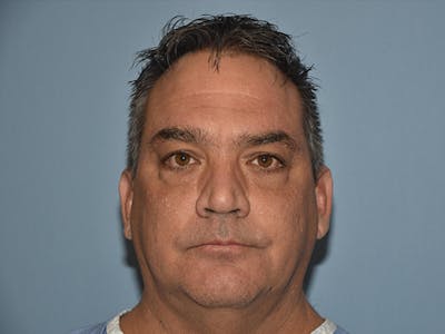Facial Fat Grafting Before & After Gallery - Patient 173624123 - Image 1