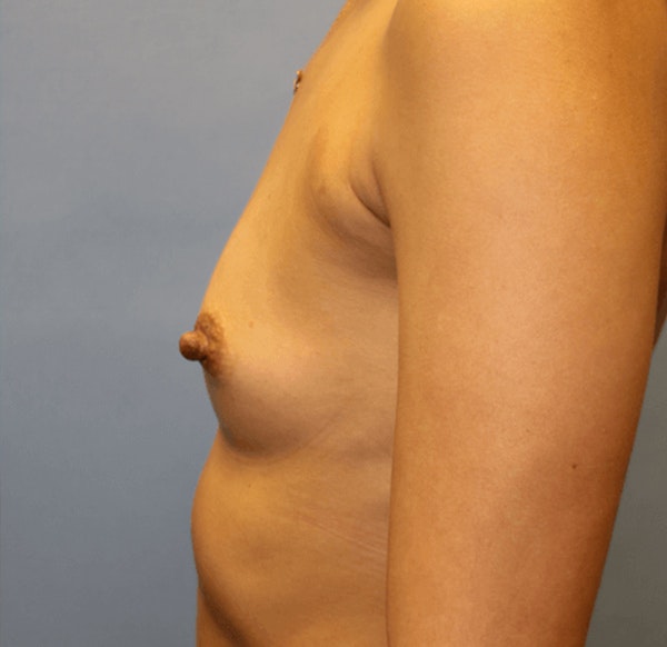 Breast Augmentation Before & After Gallery - Patient 173624096 - Image 3