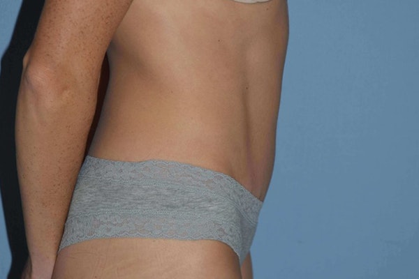 Tummy Tuck Before & After Gallery - Patient 173623994 - Image 6