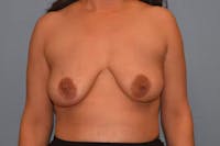 Breast Augmentation Lift Before & After Gallery - Patient 173624181 - Image 1