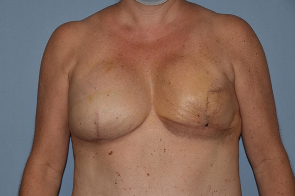Breast Reconstruction Before & After Gallery - Patient 173624152 - Image 2