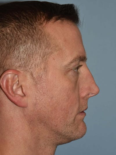 Rhinoplasty Before & After Gallery - Patient 173624195 - Image 1