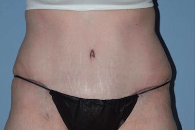 Tummy Tuck Before & After Gallery - Patient 173624189 - Image 2