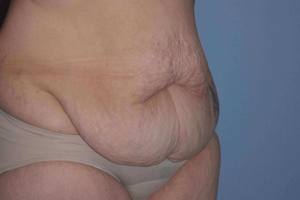 Tummy Tuck Before & After Gallery - Patient 173624189 - Image 3
