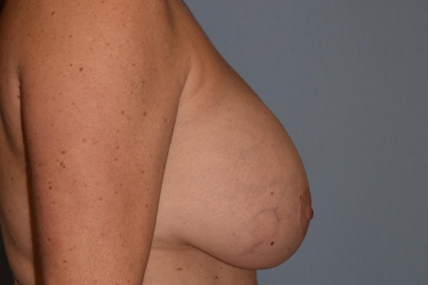 Breast Reconstruction Before & After Gallery - Patient 173624152 - Image 5