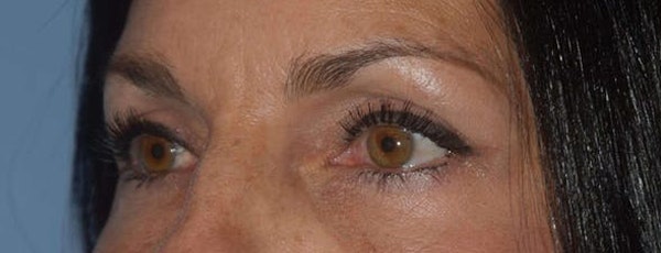Eyelid Lift Before & After Gallery - Patient 173624157 - Image 4