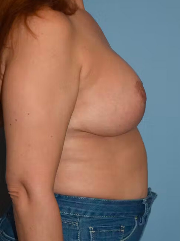 Breast Augmentation Lift Before & After Gallery - Patient 173624181 - Image 6
