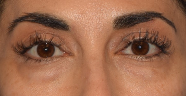 Eyelid Lift Before & After Gallery - Patient 173624250 - Image 1