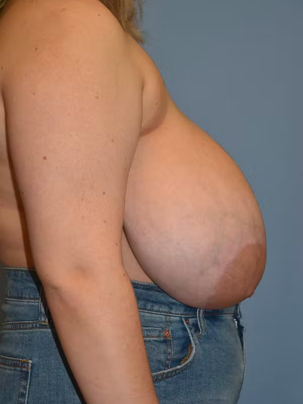 Breast Reduction Before & After Gallery - Patient 173624199 - Image 5