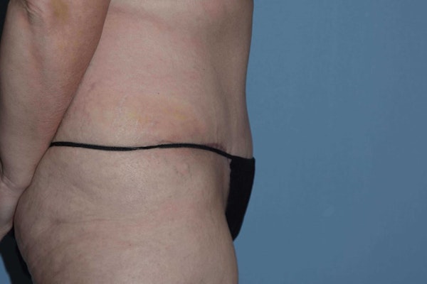 Tummy Tuck Before & After Gallery - Patient 173624189 - Image 6