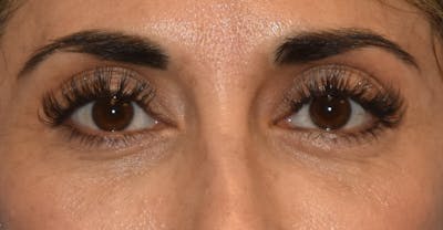 Eyelid Lift Before & After Gallery - Patient 173624250 - Image 2