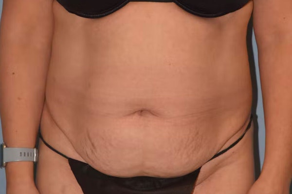 Tummy Tuck Before & After Gallery - Patient 173624253 - Image 1