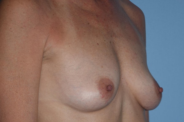 Breast Reconstruction Before & After Gallery - Patient 173624254 - Image 3