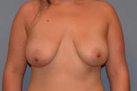 Breast Reduction Before & After Gallery - Patient 173624251 - Image 1