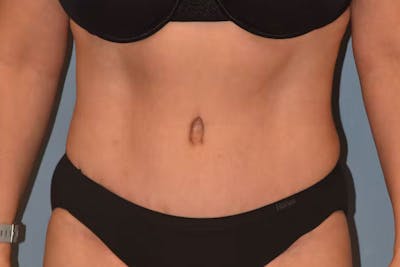 Tummy Tuck Before & After Gallery - Patient 173624253 - Image 2