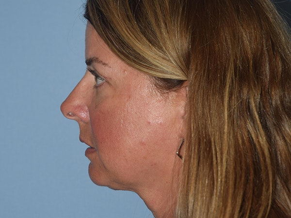 Facial Fat Grafting Before & After Gallery - Patient 173624255 - Image 6