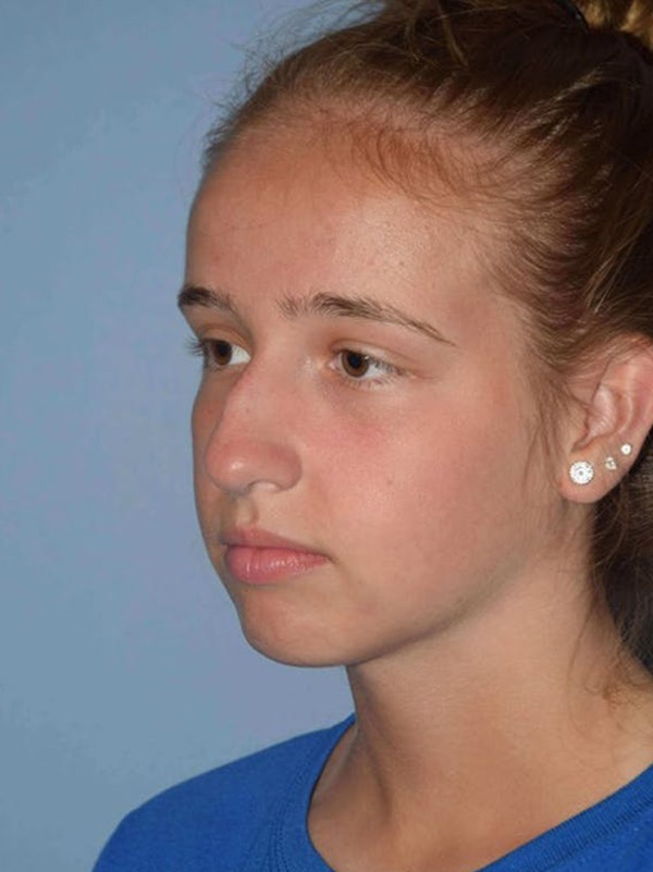 Rhinoplasty Before & After Gallery - Patient 173624258 - Image 3