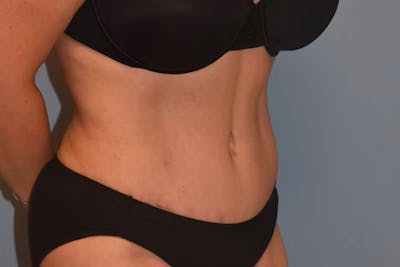 Tummy Tuck Before & After Gallery - Patient 173624253 - Image 4