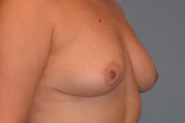 Breast Reduction Before & After Gallery - Patient 173624251 - Image 4