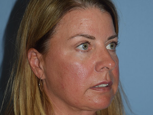 Facial Fat Grafting Before & After Gallery - Patient 173624255 - Image 8