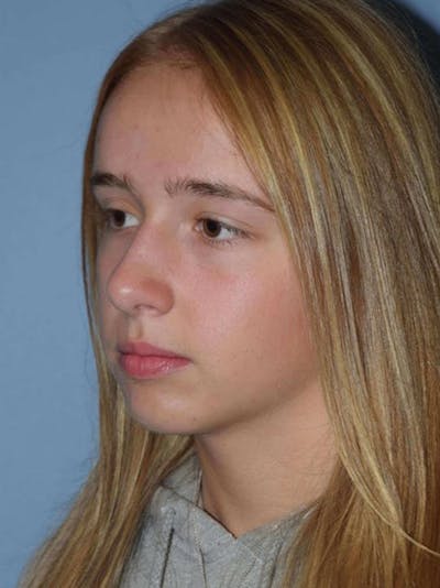 Rhinoplasty Before & After Gallery - Patient 173624258 - Image 4
