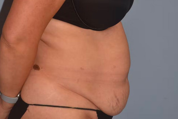 Tummy Tuck Before & After Gallery - Patient 173624253 - Image 5