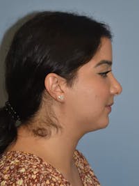 Submental Liposuction Before & After Gallery - Patient 173624262 - Image 1
