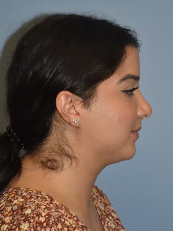 Submental Liposuction Before & After Gallery - Patient 173624262 - Image 1