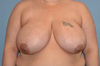 Breast Reduction Before & After Gallery - Patient 173624261 - Image 1