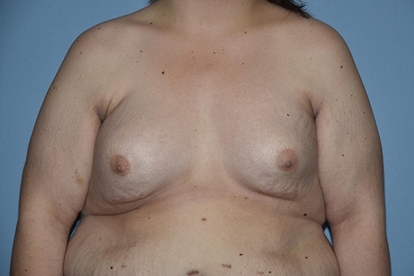 Breast Reconstruction Before & After Gallery - Patient 173624264 - Image 1