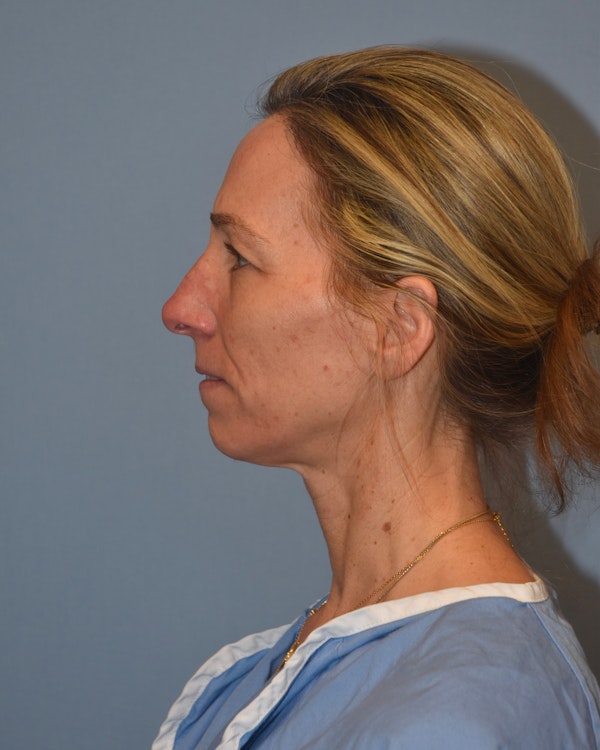 Facelift Before & After Gallery - Patient 173624270 - Image 5