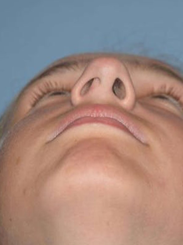 Rhinoplasty Before & After Gallery - Patient 173624258 - Image 7