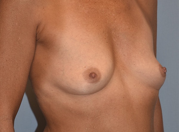 Breast Augmentation Before & After Gallery - Patient 173624259 - Image 3