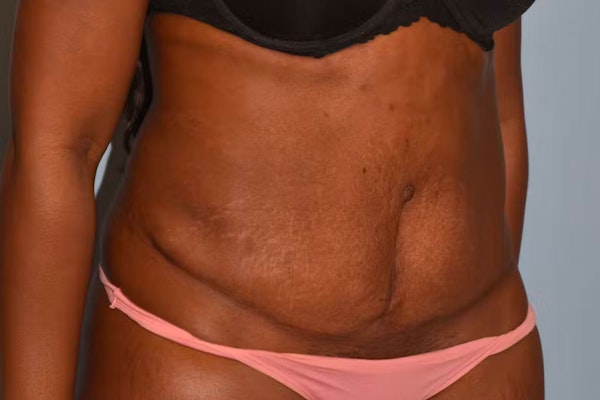 Tummy Tuck Before & After Gallery - Patient 173624260 - Image 3